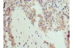 Immunohistochemistry of paraffin-embedded CSB-PA865097LA01HU using human lung cancer at dilution 1:100