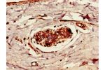 Immunohistochemistry of paraffin-embedded human breast cancer using CSB-PA865105LA01HU at dilution of 1:100