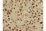 Immunohistochemistry of paraffin-embedded human glioma cancer using CSB-PA865114LA01HU at dilution of 1:100