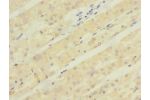 Immunohistochemistry of paraffin-embedded human gastric cancer using CSB-PA865174ESR2HU at dilution 1:100