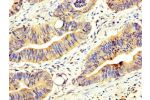 IHC image of CSB-PA866202LA01HU diluted at 1:200 and staining in paraffin-embedded human colon cancer performed on a Leica BondTM system. After dewaxing and hydration, antigen retrieval was mediated by high pressure in a citrate buffer (pH 6.0). Section w
