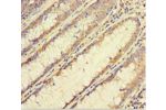 Immunohistochemistry of paraffin-embedded human colon cancer using CSB-PA866216LA01HU at dilution 1:100