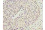 Immunohistochemistry of paraffin-embedded human cervical cancer using CSB-PA866275ESR2HU at dilution 1:100
