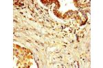 Immunohistochemistry of paraffin-embedded human breast cancer using CSB-PA866281LA01HU at dilution of 1:100