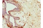 Immunohistochemistry of paraffin-embedded human breast cancer using CSB-PA866298DSR1HU at dilution 1:100