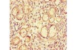 Immunohistochemistry of paraffin-embedded human gastric cancer using CSB-PA866317LA01HU at dilution of 1:100