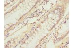 Immunohistochemistry of paraffin-embedded human colon cancer using CSB-PA866328ESR2HU at dilution 1:100