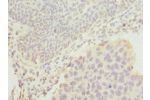 Immunohistochemistry of paraffin-embedded human bladder cancer using CSB-PA866601ESR1HU at dilution 1:100