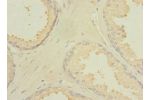 Immunohistochemistry of paraffin-embedded human prostate cancer CSB-PA867184LA01HU at dilution 1:100