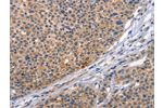 The image on the left is immunohistochemistry of paraffin-embedded Human liver cancer tissue using CSB-PA867465(CD5L Antibody) at dilution 1/30, on the right is treated with synthetic peptide. (Original magnification: 