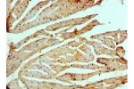 Immunohistochemistry of paraffin-embedded human prostatic cancer using CSB-PA868396ESR1HU at dilution 1:100