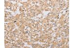 The image on the left is immunohistochemistry of paraffin-embedded Human thyroid cancer tissue using CSB-PA868793(ATG9A Antibody) at dilution 1/40, on the right is treated with fusion protein. (Original magnification: 