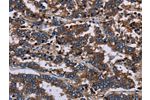The image on the left is immunohistochemistry of paraffin-embedded Human liver cancer tissue using CSB-PA869115(F11R Antibody) at dilution 1/60, on the right is treated with fusion protein. (Original magnification: 