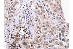 The image on the left is immunohistochemistry of paraffin-embedded Human lung cancer tissue using CSB-PA869274(EPCAM Antibody) at dilution 1/5, on the right is treated with synthetic peptide. (Original magnification: 