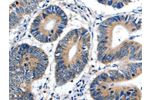 The image on the left is immunohistochemistry of paraffin-embedded Human colon cancer tissue using CSB-PA869915(CDKN1B Antibody) at dilution 1/20, on the right is treated with fusion protein. (Original magnification: 