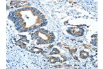 The image on the left is immunohistochemistry of paraffin-embedded Human colon cancer tissue using CSB-PA870318(GLRA1 Antibody) at dilution 1/30, on the right is treated with synthetic peptide. (Original magnification: 