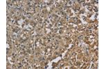 The image on the left is immunohistochemistry of paraffin-embedded Human thyroid cancer tissue using CSB-PA870342(CYB5A Antibody) at dilution 1/30, on the right is treated with fusion protein. (Original magnification: 