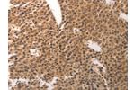 The image on the left is immunohistochemistry of paraffin-embedded Human breast cancer tissue using CSB-PA870444(CDC6 Antibody) at dilution 1/25, on the right is treated with synthetic peptide. (Original magnification: 