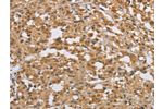 The image on the left is immunohistochemistry of paraffin-embedded Human thyroid cancer tissue using CSB-PA870531(DIDO1 Antibody) at dilution 1/50, on the right is treated with fusion protein. (Original magnification: 