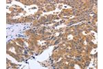 The image on the left is immunohistochemistry of paraffin-embedded Human ovarian cancer tissue using CSB-PA871262(GEMIN2 Antibody) at dilution 1/40, on the right is treated with synthetic peptide. (Original magnification: 