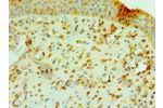 Immunohistochemistry of paraffin-embedded human prostate cancer using CSB-PA871398ESR2HU at dilution 1:100