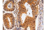 The image on the left is immunohistochemistry of paraffin-embedded Human colon cancer tissue using CSB-PA871419(CDK6 Antibody) at dilution 1/10, on the right is treated with fusion protein. (Original magnification: 