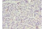 Immunohistochemistry of paraffin-embedded human ovarian cancer using CSB-PA871625LA01HU at dilution 1:100