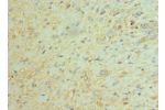 Immunohistochemistry of paraffin-embedded human glioma using CSB-PA872429ESR1HU at dilution 1:100