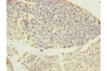 Immunohistochemistry of paraffin-embedded human cervical cancer using CSB-PA872505LA01HU at dilution of 1:100