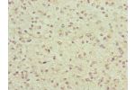 Immunohistochemistry of paraffin-embedded human glioma cancer using CSB-PA873634ESR2HU at dilution of 1:100