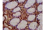 IHC image of CSB-PA873651LA01HU diluted at 1:400 and staining in paraffin-embedded human gastric cancer performed on a Leica BondTM system. After dewaxing and hydration, antigen retrieval was mediated by high pressure in a citrate buffer (pH 6.0). Section