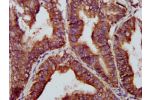 IHC image of CSB-PA873684LA01HU diluted at 1:200 and staining in paraffin-embedded human endometrial cancer performed on a Leica BondTM system. After dewaxing and hydration, antigen retrieval was mediated by high pressure in a citrate buffer (pH 6.0). Sec