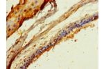 Immunohistochemistry of paraffin-embedded human breast cancer using CSB-PA873727LA01HU at dilution of 1:100