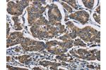 The image is immunohistochemistry of paraffin-embedded Human breast cancer tissue using CSB-PA874417(AGER Antibody) at dilution 1/70. (Original magnification: 