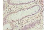 Immunohistochemistry of paraffin-embedded human colon cancer using CSB-PA874802ESR1HU at dilution 1:100