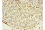 Immunohistochemistry of paraffin-embedded human breast cancer using CSB-PA874812LA01HU at dilution 1:100