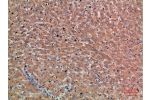Immunohistochemical analysis of paraffin-embedded human-liver-cancer, antibody was diluted at 1:200