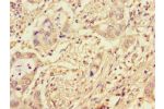 Immunohistochemistry of paraffin-embedded human pancreatic cancer using CSB-PA875721LA01HU at dilution of 1:100