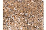 The image on the left is immunohistochemistry of paraffin-embedded Human gastic cancer tissue using CSB-PA876215(DCLK1 Antibody) at dilution 1/25, on the right is treated with synthetic peptide. (Original magnification: 