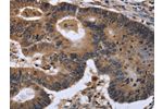 The image on the left is immunohistochemistry of paraffin-embedded Human colon cancer tissue using CSB-PA876229(FGF21 Antibody) at dilution 1/40, on the right is treated with fusion protein. (Original magnification: 