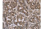 The image on the left is immunohistochemistry of paraffin-embedded Human liver cancer tissue using CSB-PA876389(FGL2 Antibody) at dilution 1/20, on the right is treated with fusion protein. (Original magnification: 
