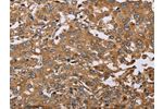 The image on the left is immunohistochemistry of paraffin-embedded Human liver cancer tissue using CSB-PA877002(DDAH1 Antibody) at dilution 1/50, on the right is treated with synthetic peptide. (Original magnification: 