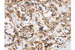 The image is immunohistochemistry of paraffin-embedded Human thyroid cancer tissue using CSB-PA877027(COX6B1 Antibody) at dilution 1/50. (Original magnification: 