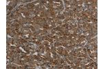 The image on the left is immunohistochemistry of paraffin-embedded Human ovarian cancer tissue using CSB-PA877207(CFLAR Antibody) at dilution 1/20, on the right is treated with synthetic peptide. (Original magnification: 