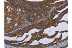 The image on the left is immunohistochemistry of paraffin-embedded Human ovarian cancer tissue using CSB-PA877434(CERS1 Antibody) at dilution 1/20, on the right is treated with synthetic peptide. (Original magnification: 