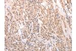 The image on the left is immunohistochemistry of paraffin-embedded Human liver cancer tissue using CSB-PA877448(ACIN1 Antibody) at dilution 1/80, on the right is treated with synthetic peptide. (Original magnification: 