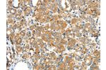 The image on the left is immunohistochemistry of paraffin-embedded Human thyroid cancer tissue using CSB-PA877573(F2 Antibody) at dilution 1/35, on the right is treated with synthetic peptide. (Original magnification: 
