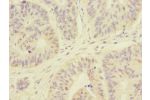 Immunohistochemistry of paraffin-embedded human colon cancer CSB-PA878863ESR1HU at dilution 1:100