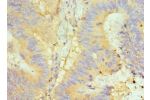 Immunohistochemistry of paraffin-embedded human colon cancer using CSB-PA878876DSR1HU at dilution 1:100