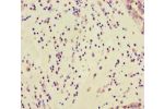 Immunohistochemistry of paraffin-embedded human lung cancer using CSB-PA878917LA01HU at dilution of 1:100